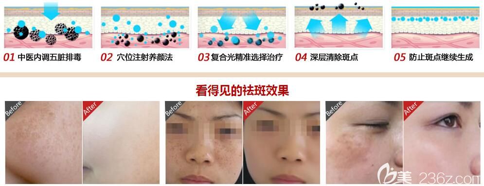 趙堅鋼院長祛斑技術(shù)及案例效果