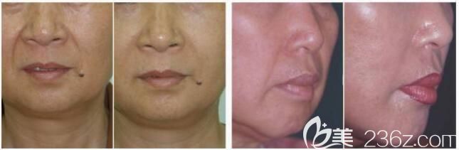 趙堅鋼除皺案例對比照