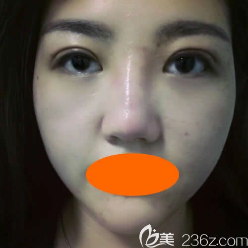 找景德鎮(zhèn)圣嘉麗院長劉志強做眼綜合+鼻綜合術(shù)后第7天效果圖 找景德鎮(zhèn)圣嘉麗院長劉志強做眼綜合+鼻綜合術(shù)后第7天效果圖