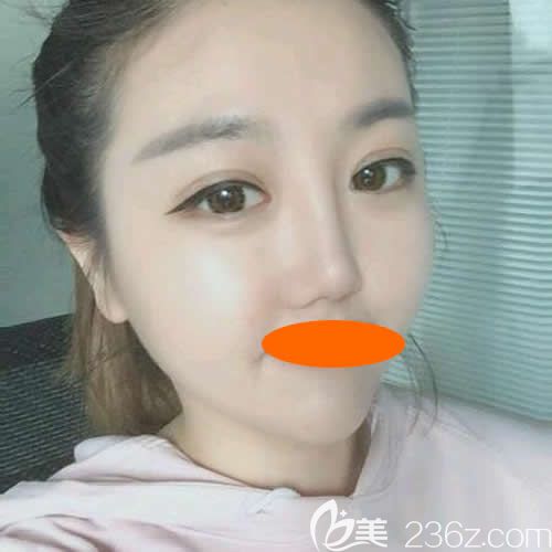 找景德鎮(zhèn)圣嘉麗院長劉志強做眼綜合+鼻綜合術(shù)后第20天效果 找景德鎮(zhèn)圣嘉麗院長劉志強做眼綜合+鼻綜合術(shù)后第20天效果