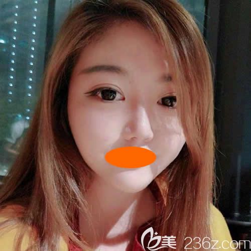 找景德鎮(zhèn)圣嘉麗院長劉志強做眼綜合+鼻綜合術(shù)后第48天效果 找景德鎮(zhèn)圣嘉麗院長劉志強做眼綜合+鼻綜合術(shù)后第48天效果