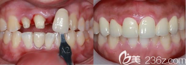廈門登特口腔候紅醫(yī)生美容冠案例效果對(duì)比圖 廈門登特口腔候紅醫(yī)生美容冠案例效果對(duì)比圖