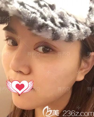 在石家莊雅芳亞做眼鼻整形術(shù)后7天進(jìn)行拆線