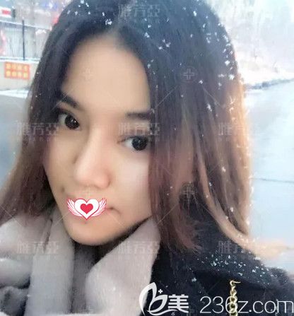 雅芳亞整形院長王文明為我做眼鼻整形術(shù)后18天恢復(fù)差不多