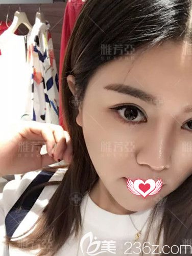 在石家莊雅芳亞做眼鼻整形術(shù)后26天已經(jīng)消腫