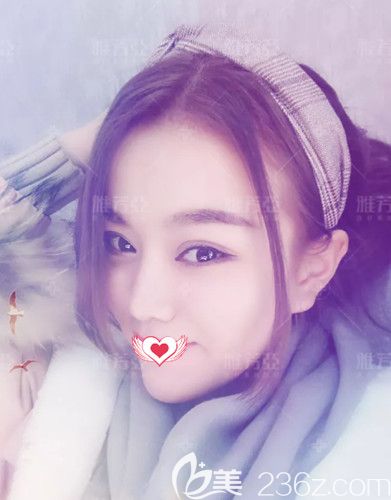 王文明院長為我做雙眼皮和鼻綜合術(shù)后改善凸嘴問題