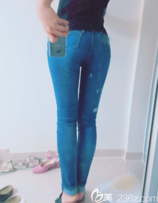  維摩整形外科姜在九吸脂案例