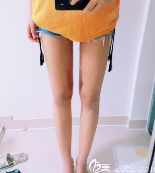 姜在九做吸脂好嗎