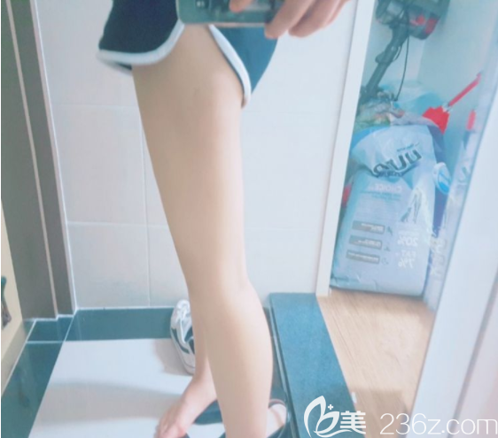 吸脂術(shù)后三個(gè)月