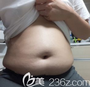 在韓國(guó)365mc整形醫(yī)院做完吸脂手術(shù)前 在韓國(guó)365mc整形醫(yī)院做完吸脂手術(shù)前