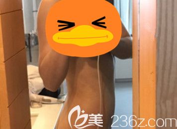 在韓國(guó)365mc整形醫(yī)院做完吸脂手術(shù)后1個(gè)月 在韓國(guó)365mc整形醫(yī)院做完吸脂手術(shù)后1個(gè)月