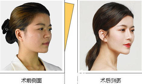 濟(jì)寧韓美隆鼻案例