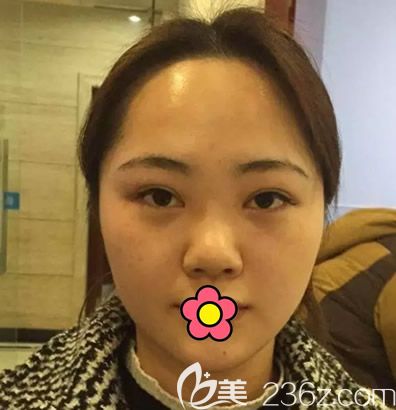 呼和浩特張高貴醫(yī)療美容門診部張高貴術前照片1