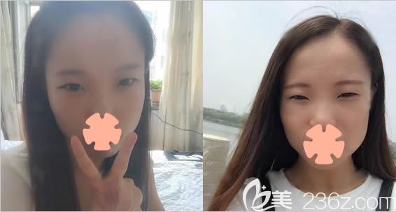 我做眼綜合整形前的照片 我做眼綜合整形前的照片