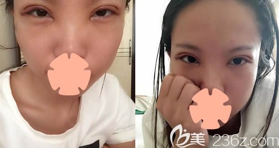 在長春奧拉克整形做雙眼皮+開眼角術(shù)后4天照 在長春奧拉克整形做雙眼皮+開眼角術(shù)后4天照