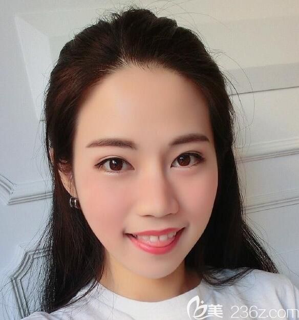 合肥壹美尚全臉線雕術(shù)后第3天