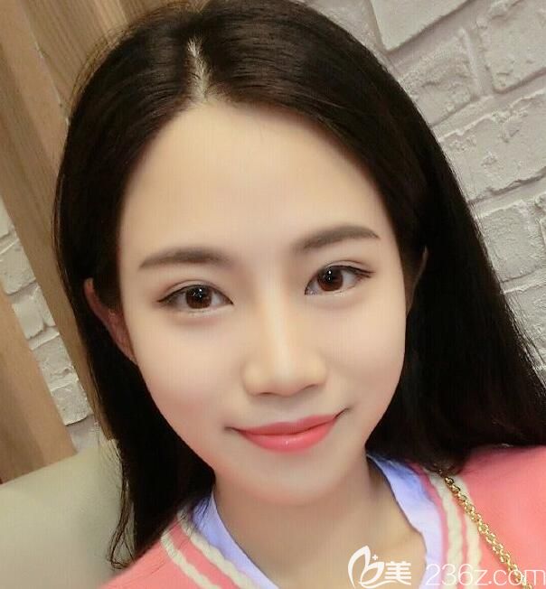 壹美尚臉部埋線提升第7天恢復(fù)情況