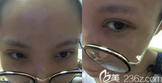 在長春奧拉克做雙眼皮+開眼角術(shù)后7天照 在長春奧拉克做雙眼皮+開眼角術(shù)后7天照