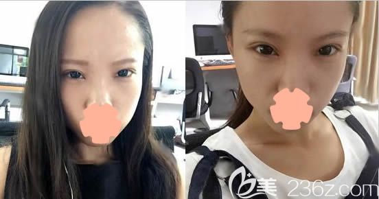 長(zhǎng)春奧拉克做雙眼皮+開(kāi)眼角價(jià)格挺優(yōu)惠，至于效果嘛請(qǐng)看本人45天的無(wú)美顏恢復(fù)圖