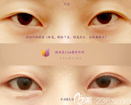 韓國美line非切開眼綜合案例