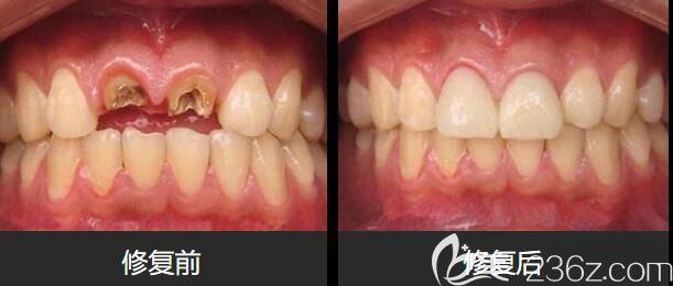 張勇前牙美學種植案例前后效果圖 張勇前牙美學種植案例前后效果圖