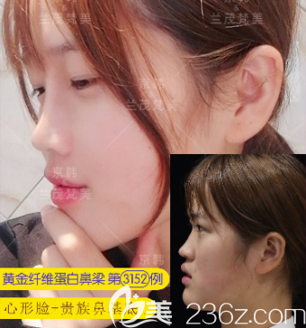 北京京韓張振醫(yī)生心形臉+鼻基底填充案例
