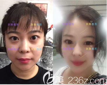 北京京韓張振醫(yī)生埋線(xiàn)提升案例