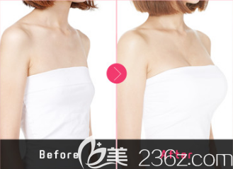 魔笛假體隆胸真人案例前后效果對比圖