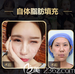 濟(jì)南美蓮整形醫(yī)院自體脂肪填充案例
