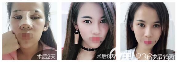 曾高醫(yī)生隆鼻案例 曾高醫(yī)生隆鼻案例