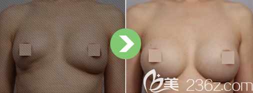 韓國麥恩李圣郁隆胸失敗修復(fù)案例效果對比圖