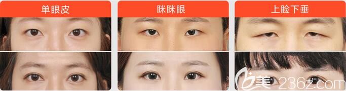 哈爾濱臻美王丹丹雙眼皮效果