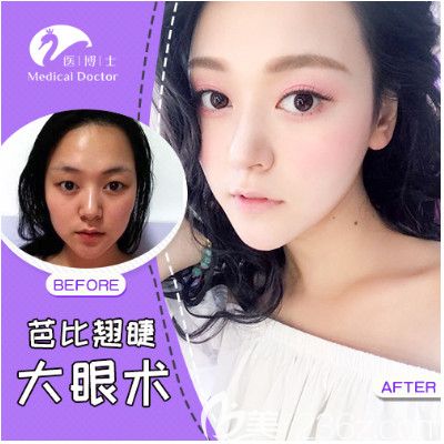 佛山醫(yī)博士劉哲醫(yī)生雙眼皮案例