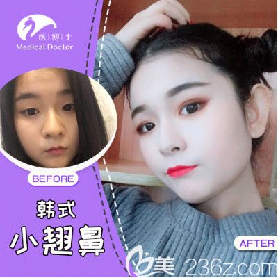 佛山醫(yī)博士門診劉哲隆鼻案例