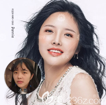 貴陽(yáng)華美自體脂肪全臉填充效果好不好