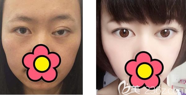 呼和浩特大韓整形失敗修復(fù)案例上線 韓國JK整形醫(yī)院白惠援院長(zhǎng)雙眼皮隆鼻修復(fù)失敗效果真的很自然