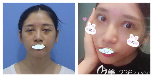 孝感天妃整形柳肖醫(yī)生雙眼皮失敗修復(fù)，全切眼部綜合+玻尿酸墊下巴術(shù)后案例照