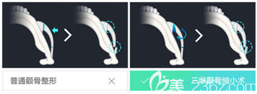 顴骨內(nèi)推示意圖