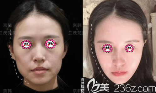 北京京韓喬愛軍面部吸脂