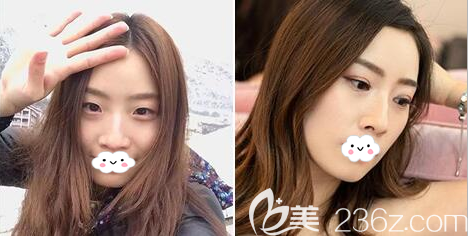 成都美極王偉雙眼皮術(shù)前術(shù)后對比圖 成都美極王偉雙眼皮術(shù)前術(shù)后對比圖