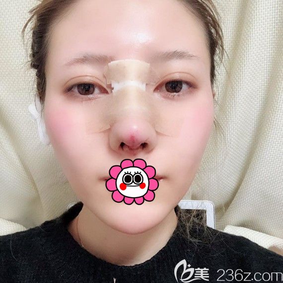 哈爾濱臻美鼻綜合術(shù)后即刻