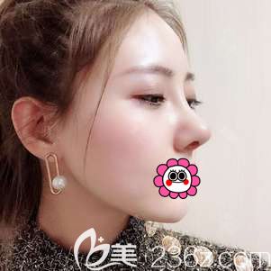 王丹丹肋軟骨隆鼻半個月效果