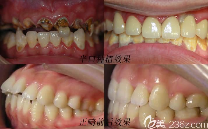 泉州維樂口腔種植牙和正畸效果對比圖 泉州維樂口腔種植牙和正畸效果對比圖