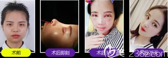 韓國顯微8美眼和韓國BSK生態(tài)肋骨隆鼻術(shù)后25恢復(fù)效果 韓國顯微8美眼和韓國BSK生態(tài)肋骨隆鼻術(shù)后25恢復(fù)效果