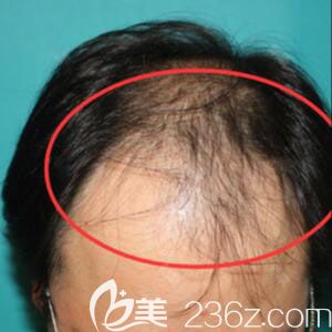 韓國毛杰琳頭頂植發(fā)術(shù)前照片 韓國毛杰琳頭頂植發(fā)術(shù)前照片