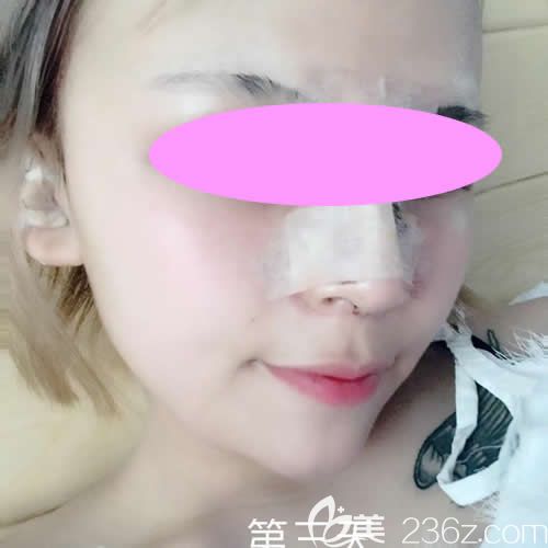 我找西寧時(shí)光祁永章做假體+自體肋骨鼻綜合術(shù)后第3天