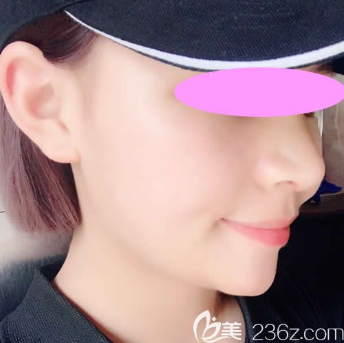 我找西寧時(shí)光祁永章做假體+自體肋骨鼻綜合術(shù)后第7天