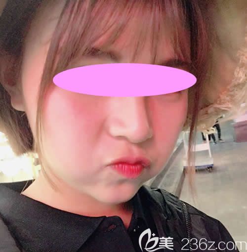 我找西寧時(shí)光祁永章做假體+自體肋骨鼻綜合術(shù)后第15天