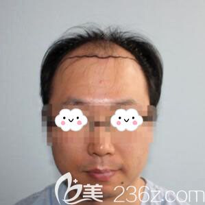 韓國毛杰琳植發(fā)真人案例 韓國毛杰琳植發(fā)真人案例