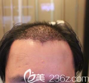 韓國毛杰琳植發(fā)術(shù)后第2天照片 韓國毛杰琳植發(fā)術(shù)后第2天照片